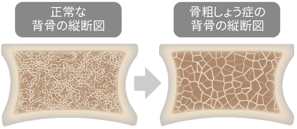 正常な背骨の断面図、骨粗しょう症の背骨の断面図