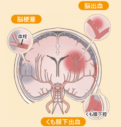 図：脳出血、脳梗塞（血栓）、くも膜下出血（くも膜下腔）