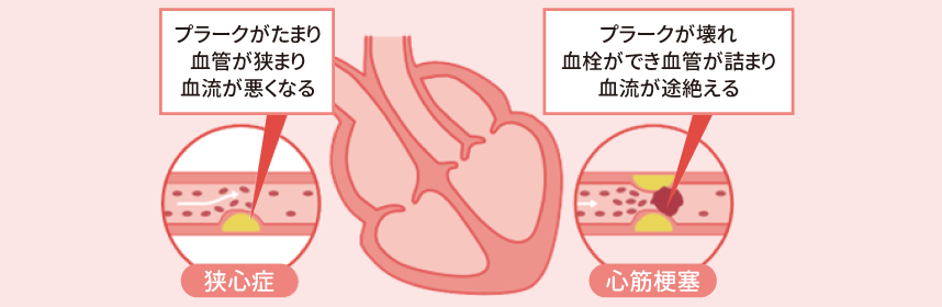 狭心症と心筋梗塞のイメージ画像